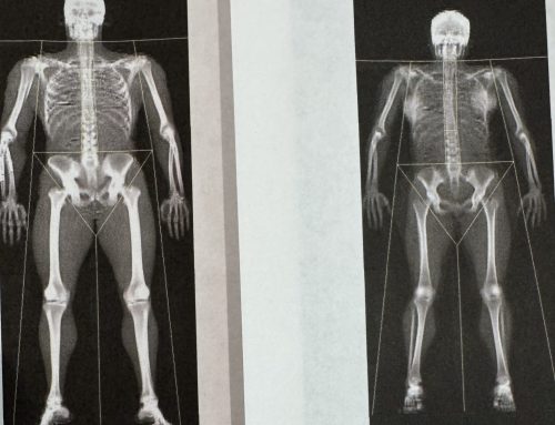 Lauren’s Bone Density Scan